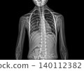 X-ray snapshot of childhood scoliosis 140112382