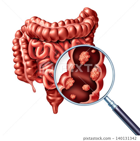 Colorectal Cancer Screening Colorectal Cancer Screening 140131342