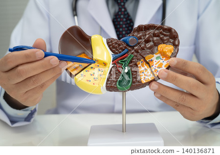 Cirrhosis, Liver cancer, fatty liver, Asian doctor with liver human model. Cirrhosis, Liver cancer, fatty liver, Asian doctor with liver human model. 140136871