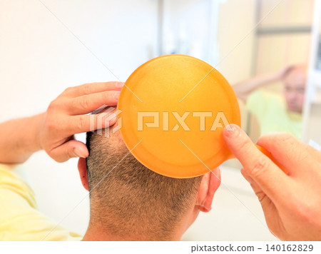 A middle-aged man suffering from hair loss A middle-aged man suffering from hair loss 140162829