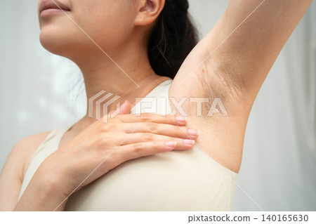 Asian woman have problem black armpit beauty skin care. Asian woman have problem black armpit beauty skin care. 140165630