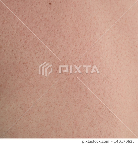 Macro texture of human male skin redness after using acupressure mat Macro texture of human male skin redness after using acupressure mat 140170623