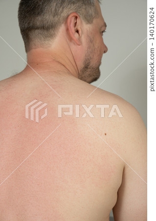 Back view of shirtless man showing skin redness after acupuncture massage Back view of shirtless man showing skin redness after acupuncture massage 140170624