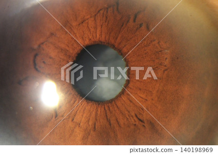 Anterior segment image demonstrating cortical lens changes Anterior segment image demonstrating cortical lens changes 140198969