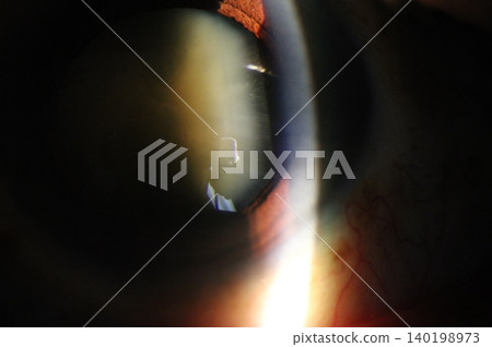 Cataractous lens demonstrating nuclear sclerosis under slit-lamp 140198973