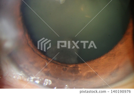 Clinical close-up photograph showing atypical cortical lens opacity 140198976