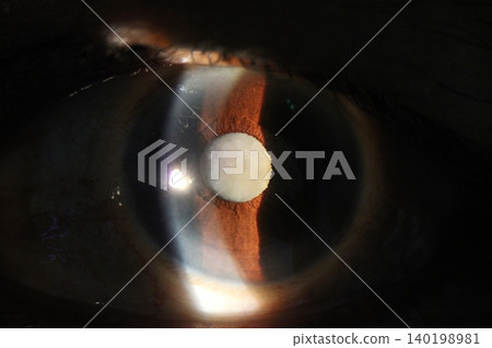 Close up of the nuclear senile cataract during slit lamp examination under slit illumination, mature cataract, nuclear sclerosis cataract Close up of the nuclear senile cataract during slit lamp examination under slit illumination, mature cataract, nuclear sclerosis cataract 140198981