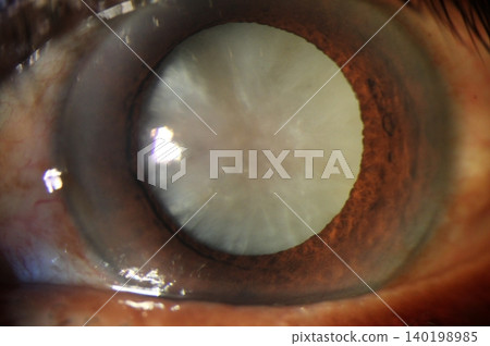 Close-up image of a dense white mature cataract observed during ophthalmic examination Close-up image of a dense white mature cataract observed during ophthalmic examination 140198985
