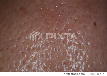 Close-up of Human Skin Texture with Pores and Oil Close-up of Human Skin Texture with Pores and Oil 140200714