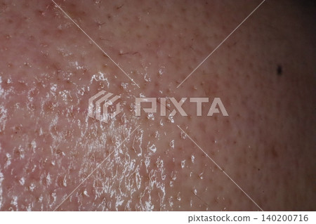 Close-Up of Human Skin Texture with Pores and Moisture Close-Up of Human Skin Texture with Pores and Moisture 140200716
