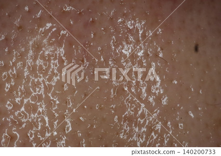 Close-up of Dry Skin with Flakes Close-up of Dry Skin with Flakes 140200733