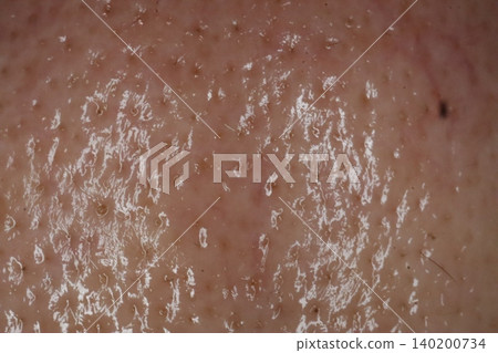 Close-up of Human Skin Texture with Flakes Close-up of Human Skin Texture with Flakes 140200734