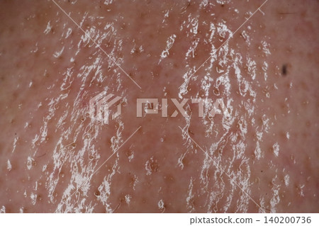 Dry Skin Texture with White Flakes Dry Skin Texture with White Flakes 140200736
