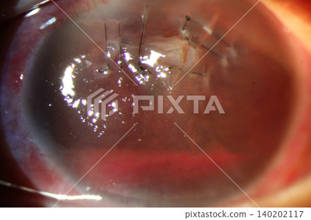 Anterior chamber hyphema following penetrating corneal injury with corneal sutures Anterior chamber hyphema following penetrating corneal injury with corneal sutures 140202117