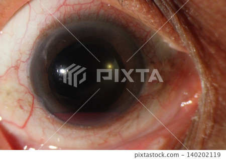 Anterior segment image demonstrating blood accumulation in the anterior chamber Anterior segment image demonstrating blood accumulation in the anterior chamber 140202119