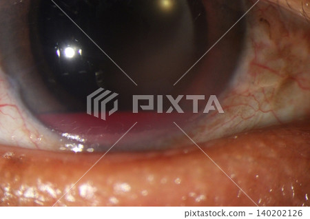 Clinical slit lamp photo of traumatic hyphema Clinical slit lamp photo of traumatic hyphema 140202126