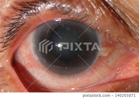 Mid-dilated pupil. Slit lamp photograph showing a mid-dilated pupil accompanied by early opacity of the crystalline lens, suggestive of developing lenticular changes 140203871