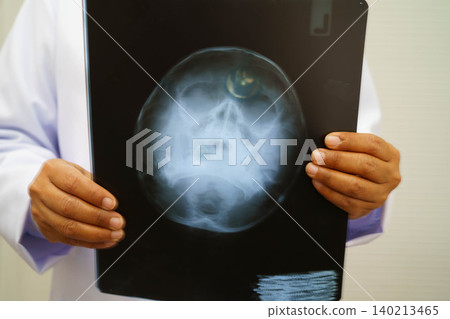 Alzheimer disease, Asian doctor holding brain anatomy model for study diagnosis and treatment in hospital. Alzheimer disease, Asian doctor holding brain anatomy model for study diagnosis and treatment in hospital. 140213465