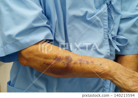 Ecchymosis, elderly bleeding on her arm after taking aspirin. Ecchymosis, elderly bleeding on her arm after taking aspirin. 140213594