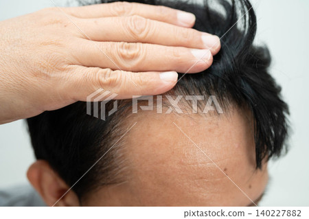 Bald in the middle head and begin no loss hair glabrous of mature man. 140227882