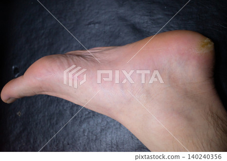Blisters on the feet Blisters on the feet 140240356