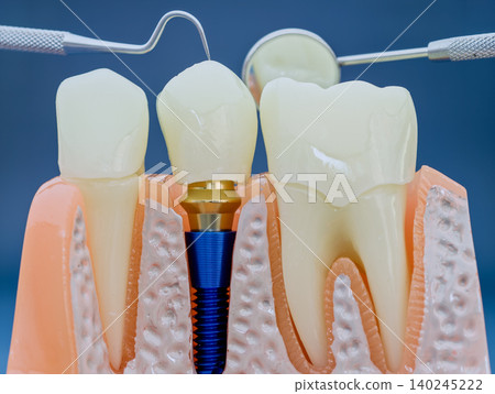 Dental Implant Crown Model With Mirror And Probe Dental Implant Crown Model With Mirror And Probe 140245222