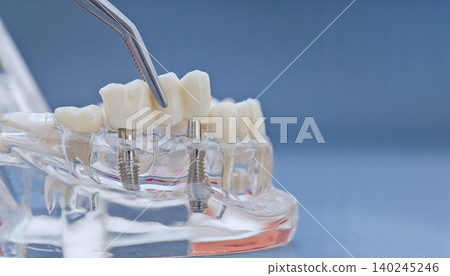 Dental bridge placement on implants concept. Transparent jaw model with tweezers and copy space for text. 140245246