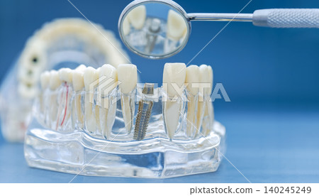 Dental implant placement concept. Transparent jaw model with titanium screw, abutment, and dental mirror on blue background. Dental implant placement concept. Transparent jaw model with titanium screw, abutment, and dental mirror on blue background. 140245249