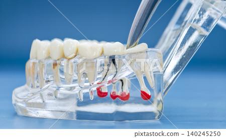 Endodontics and dental pathology concept. Transparent jaw model showing root canal infection, cyst, and inflamed nerve with dentist tool. Endodontics and dental pathology concept. Transparent jaw model showing root canal infection, cyst, and inflamed nerve with dentist tool. 140245250