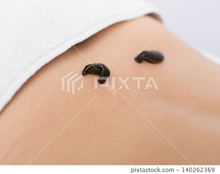 patient during leech therapy, alternative Hirudotherapy, blood purification patient during leech therapy, alternative Hirudotherapy, blood purification 140262369