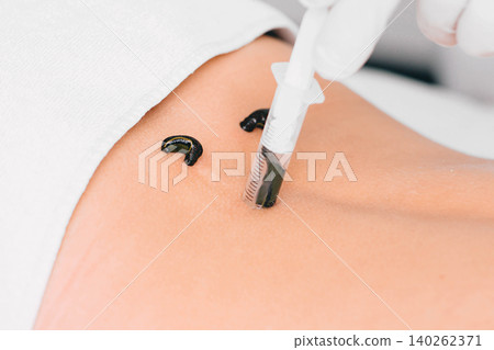 patient during leech therapy, alternative Hirudotherapy, blood purification patient during leech therapy, alternative Hirudotherapy, blood purification 140262371