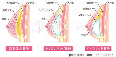 隆乳手術類型;整形手術;乳房 隆乳手術類型;整形手術;乳房 140277527