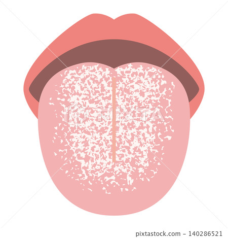 White tongue (tongue coating) White tongue (tongue coating) 140286521