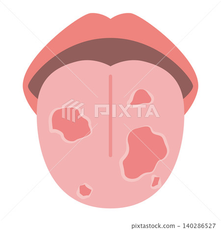 Spotted tongue (geographic tongue) Spotted tongue (geographic tongue) 140286527
