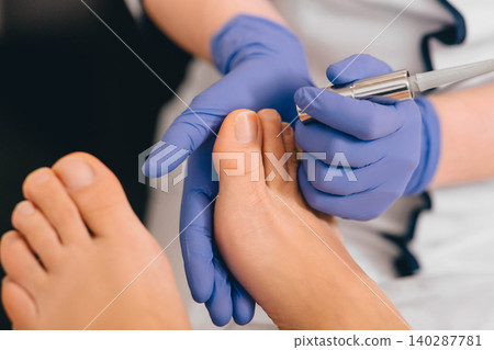 laser treatment on toenail, fungal infection on the toenails laser treatment on toenail, fungal infection on the toenails 140287781