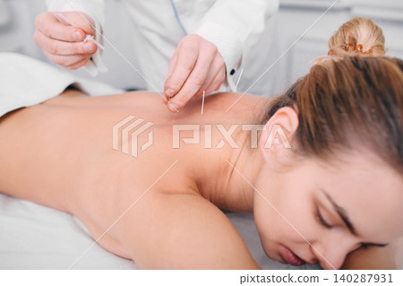 Client having acupuncture treatment on her back 140287931