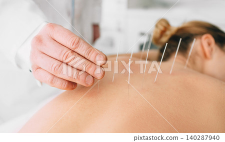 Woman having acupuncture treatment on her back 140287940