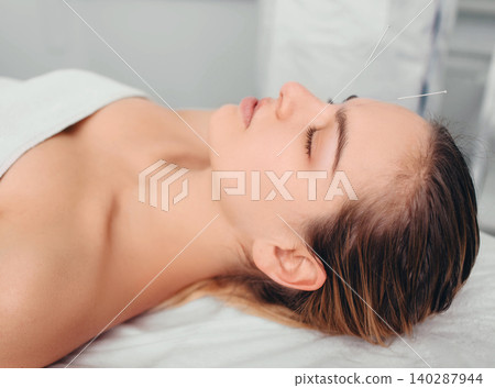 beautiful woman with acupuncture needles on her face 140287944