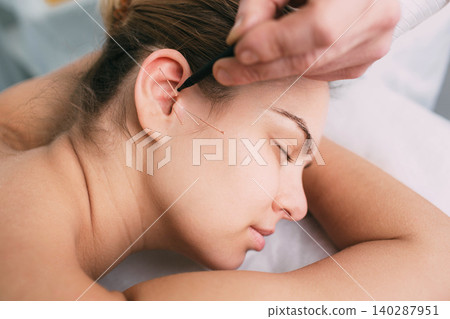 Acupuncturist inserting a needle into a female face 140287951