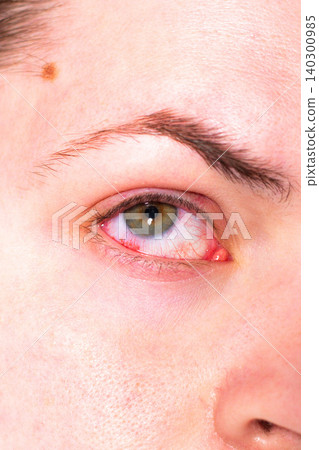 Conjunctivitis making eye bloodshot and swollen. Patient at ophthalmology clinic. Doctor using slit lamp for diagnosis. Eye infection treatment with antibacterial drops Conjunctivitis making eye bloodshot and swollen. Patient at ophthalmology clinic. Doctor using slit lamp for diagnosis. Eye infection treatment with antibacterial drops 140300985