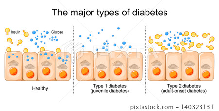 The major types of diabetes comparison. The major types of diabetes comparison. 140323131
