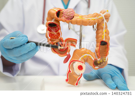 Colorectal cancer, doctor holding intestine colon human anatomy model. Colorectal cancer, doctor holding intestine colon human anatomy model. 140324781