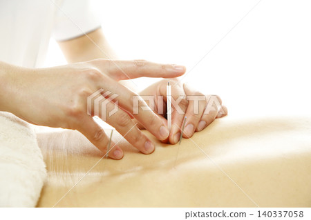 A woman's back receiving acupuncture treatment; an image of a treatment session in a bright and clean clinic. A woman's back receiving acupuncture treatment; an image of a treatment session in a bright and clean clinic. 140337058