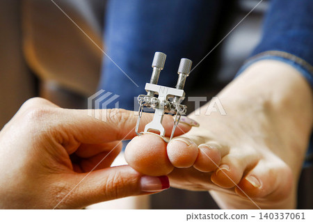Image of a nail salon or foot care treatment: A device for correcting ingrown toenails is being fitted to the big toe. Image of a nail salon or foot care treatment: A device for correcting ingrown toenails is being fitted to the big toe. 140337061