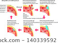 Schematic diagram of the process from vascular injury to hemostasis, blood coagulation, and vascular repair (in German) 140339592