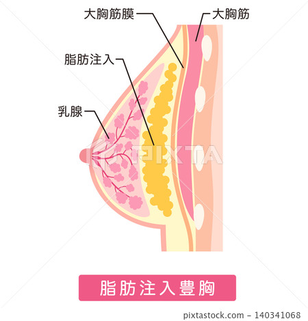 自體脂肪隆乳;隆乳手術類型;整形手術;乳房 自體脂肪隆乳;隆乳手術類型;整形手術;乳房 140341068
