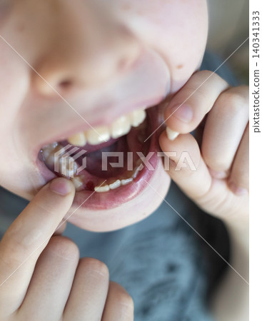 A 10-year-old boy shows a fresh empty socket in his lower jaw after losing a baby tooth. He holds the shed milk tooth in his hand, highlighting natural childhood development and dental growth. 140341333