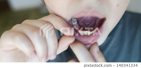 A 10-year-old boy shows a fresh empty socket in his lower jaw after losing a baby tooth. He holds the shed milk tooth in his hand, highlighting natural childhood development and dental growth. A 10-year-old boy shows a fresh empty socket in his lower jaw after losing a baby tooth. He holds the shed milk tooth in his hand, highlighting natural childhood development and dental growth. 140341334
