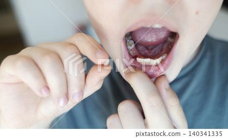 A 10-year-old boy shows a fresh empty socket in his lower jaw after losing a baby tooth. He holds the shed milk tooth in his hand, highlighting natural childhood development and dental growth. 140341335