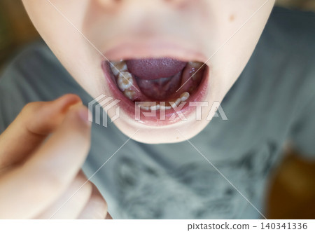 A 10-year-old boy shows a fresh empty socket in his lower jaw after losing a baby tooth. He holds the shed milk tooth in his hand, highlighting natural childhood development and dental growth. 140341336